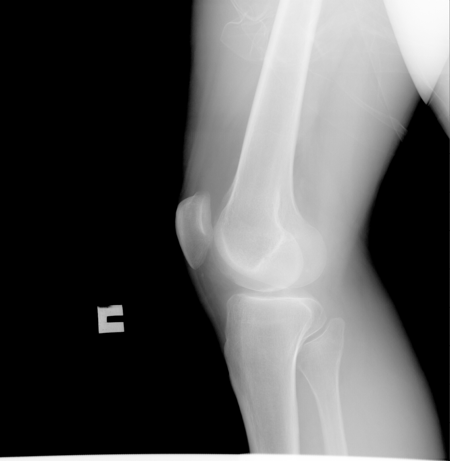 Рентген колена. Доа коленных суставов 3 ст рентген. Синовит коленного сустава рентген. Синовит коленного суставаренген. Синовит коленного сустава РЕН.