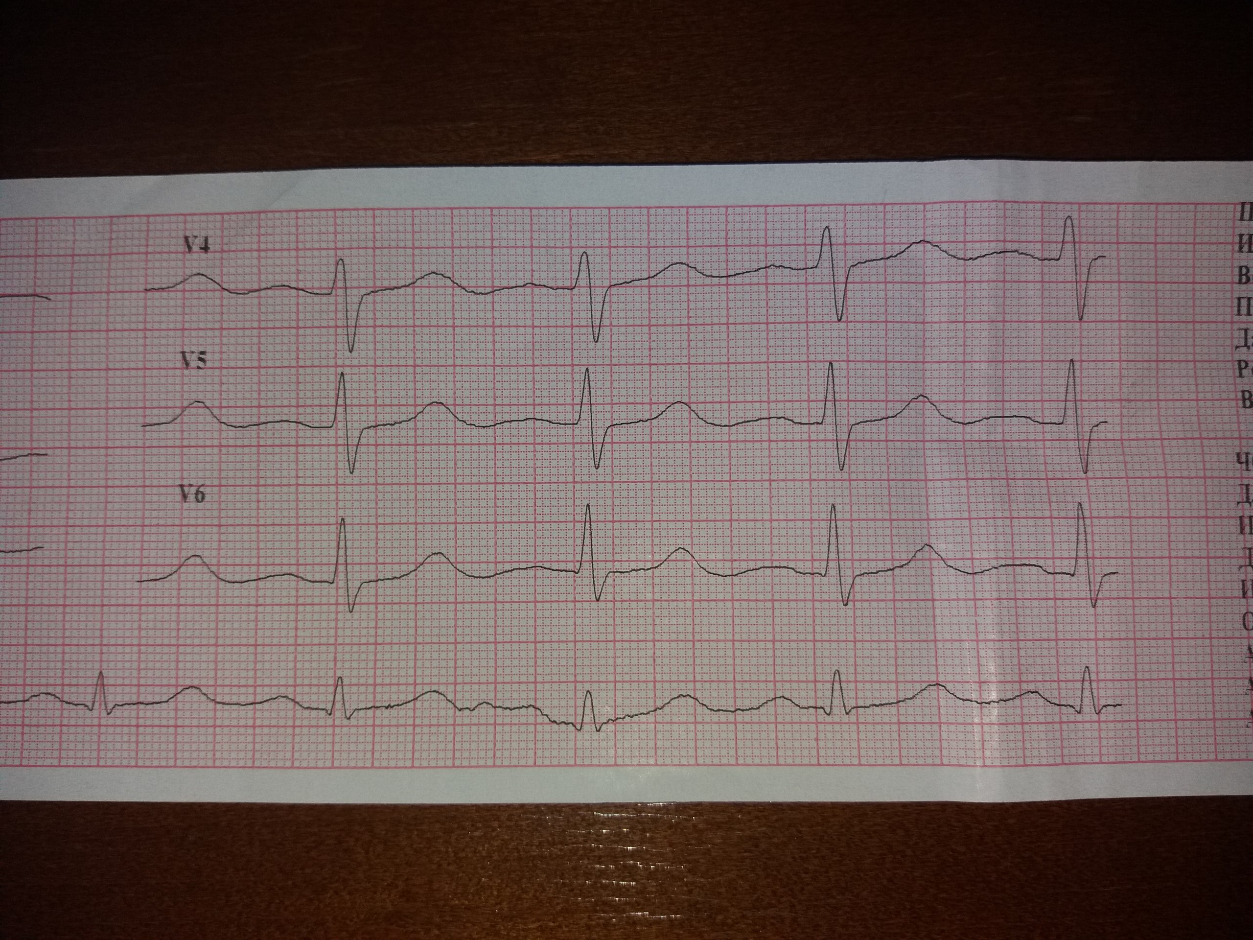 Экг 22. Результаты ЭКГ. Нормальная ЭКГ. ЭКГ снимки. Кардиограмма сердца.