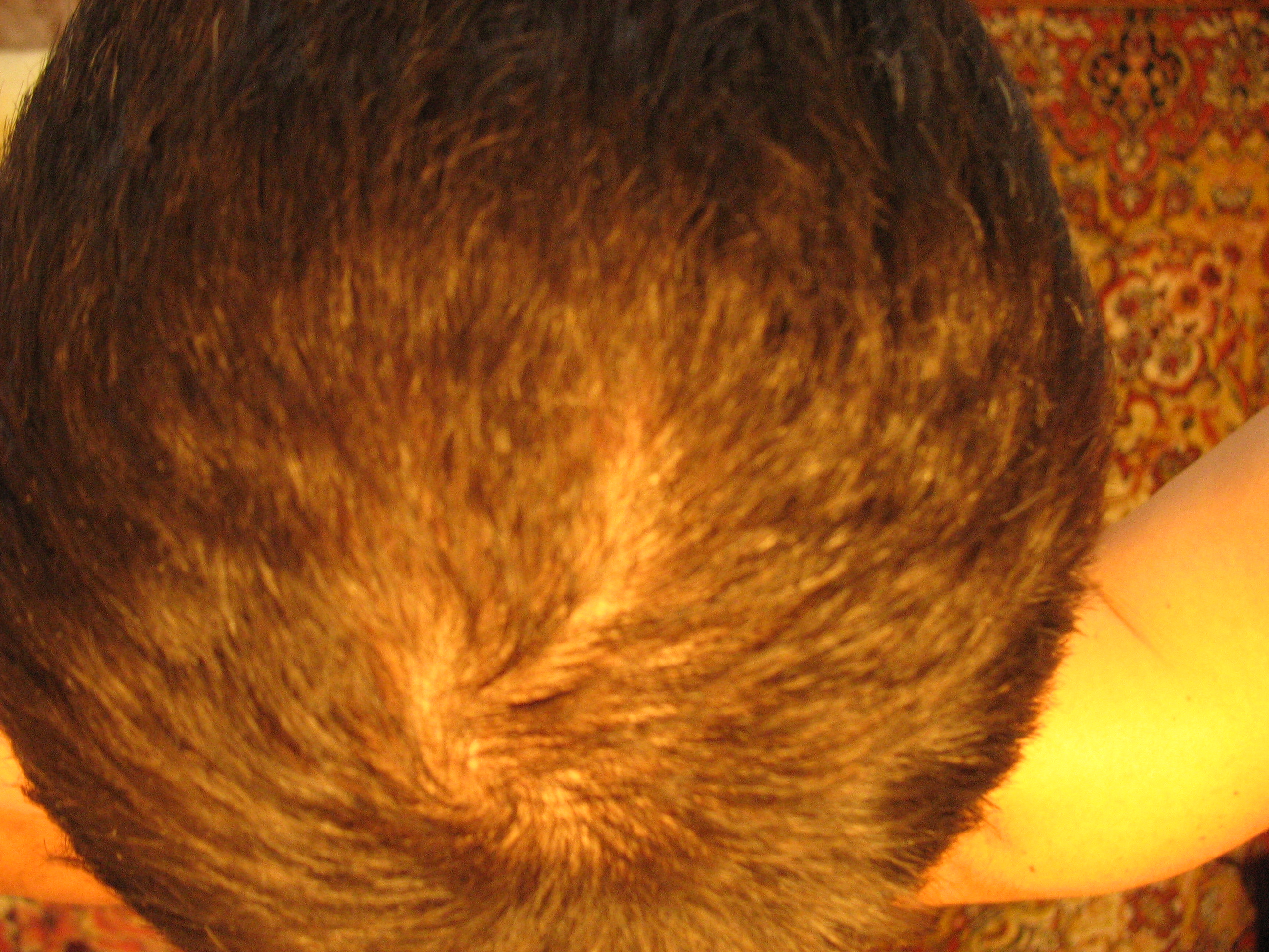 Когда начинается наследственное выпадение волос?