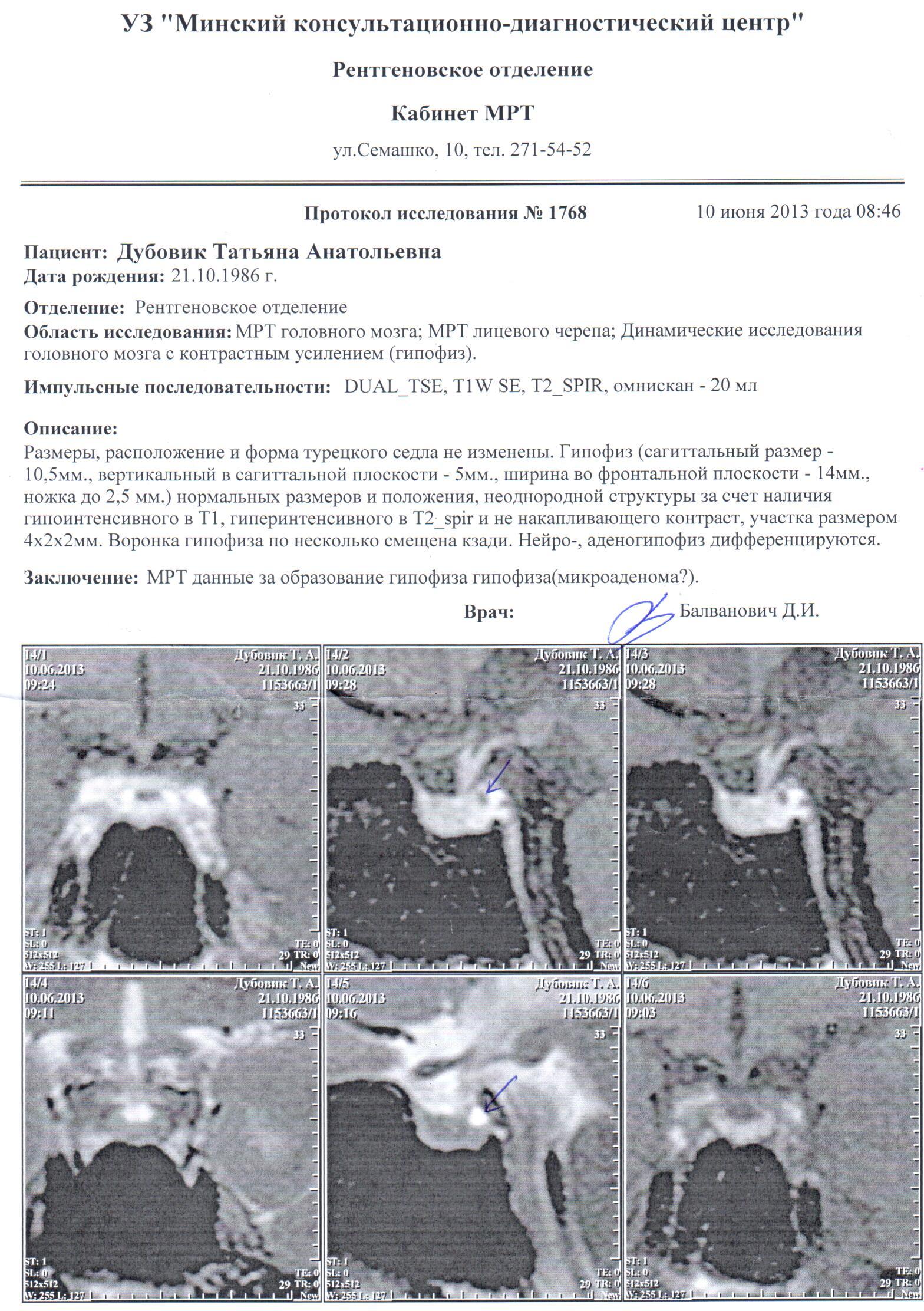 Микроаденома гипофиза - симптомы, лечение, последствия удаления и прогноз