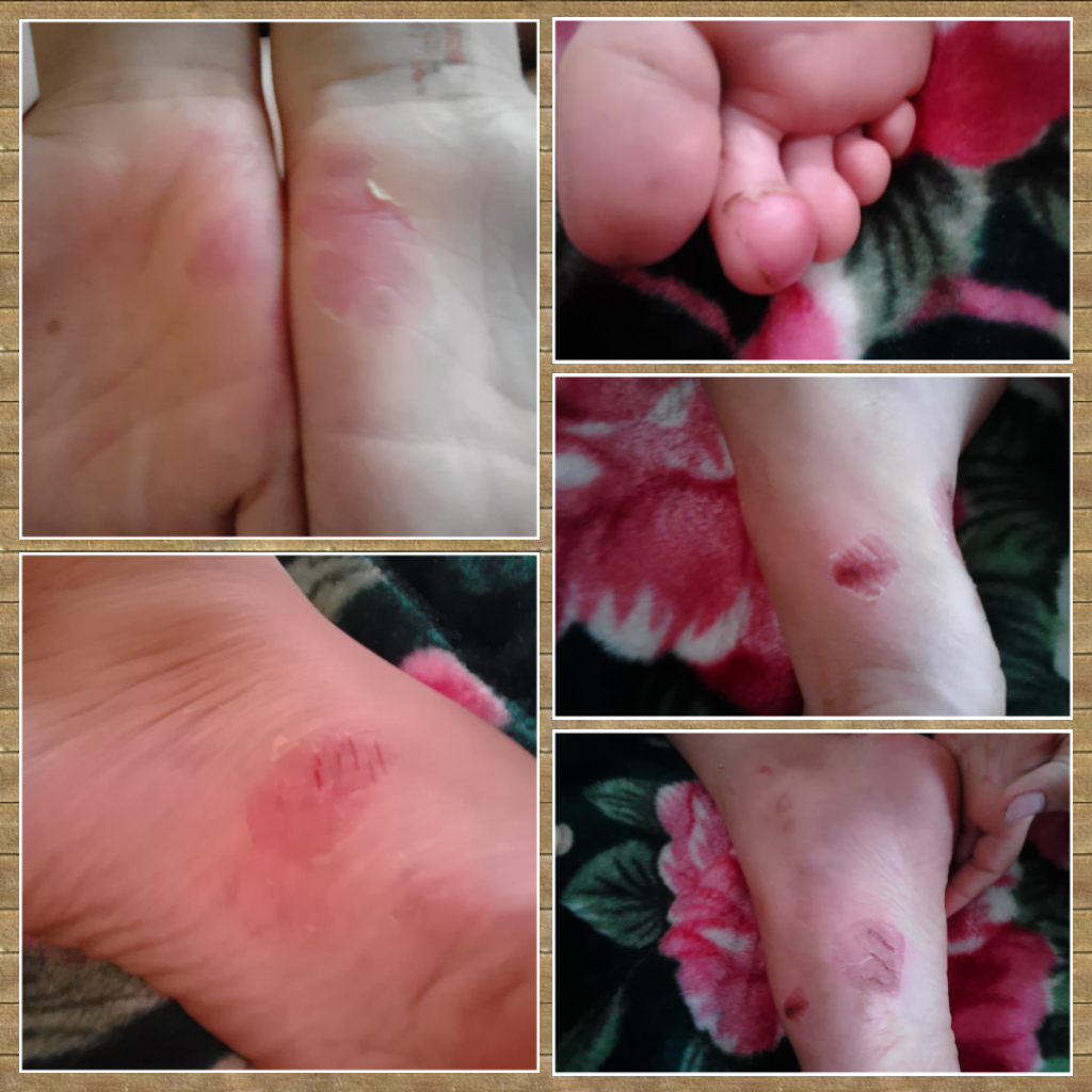 Причины сухости, шелушения и зуда кожи ног — EVO Laboratoires