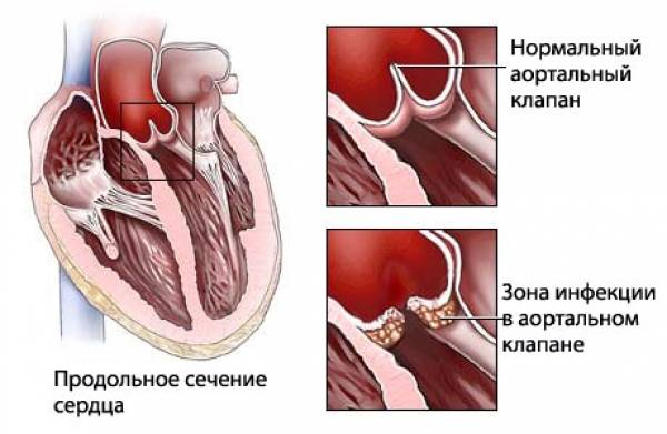 Инфекционный эндокардит.  