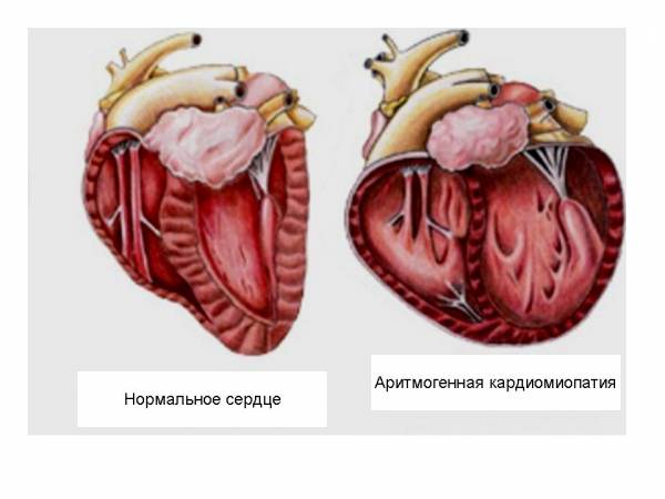 Аритмогенная кардиомиопатия (АКМП). Лечение