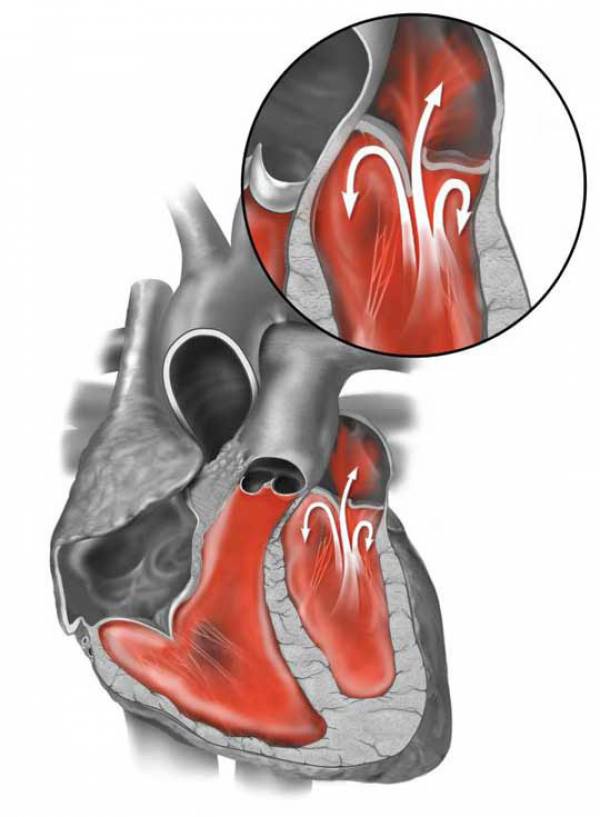 Малые аномалии развития сердца (МАРС)