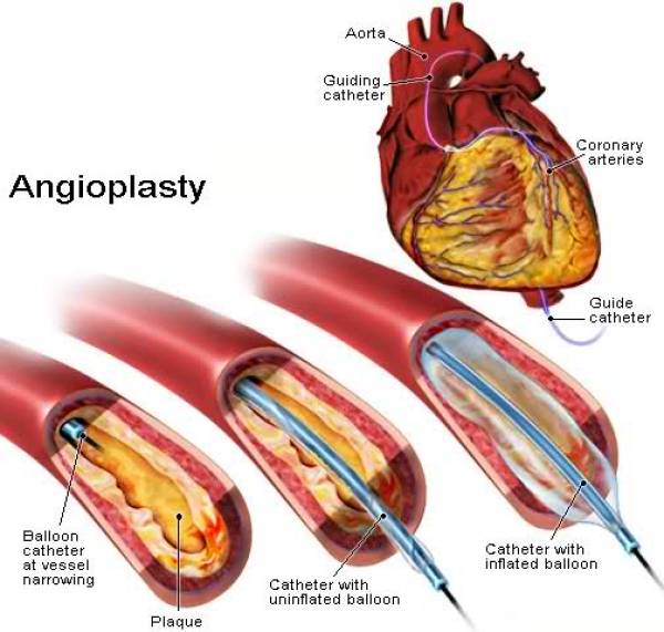 Эффективность выполнения профилактической ангиопластики коронарных артерий у больных с инфарктом миокарда