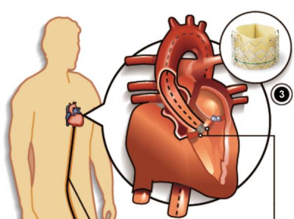 Сравнительная эффективность приема дабигатрана и варфарина у больных с имплантированными механическими протезами клапанов сердца