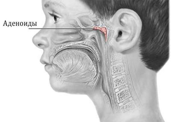 Аденоиды: удалять или нет?