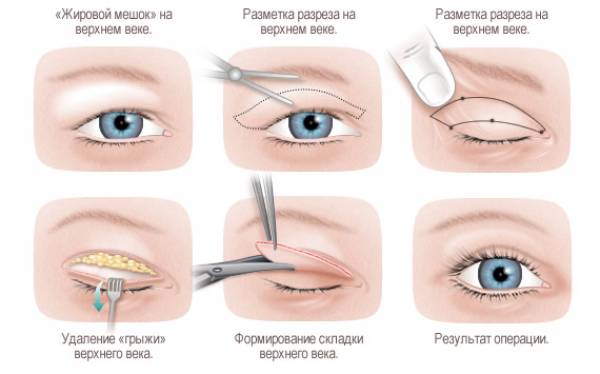 Блефаропластика (пластика век) в Минске