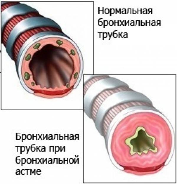 Бронхиальная астма: лечение обострения