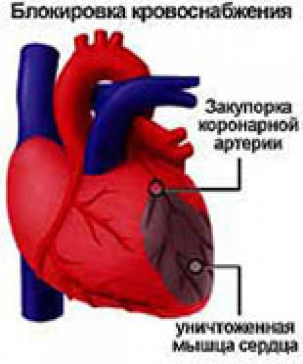 После сердца. Нарушение кровоснабжения миокарда. Кровоснабжение сердца и инфаркт. Сердце после инфаркта миокарда.