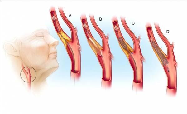 Стенозы сонных артерий. Высокотехнологичное лечение