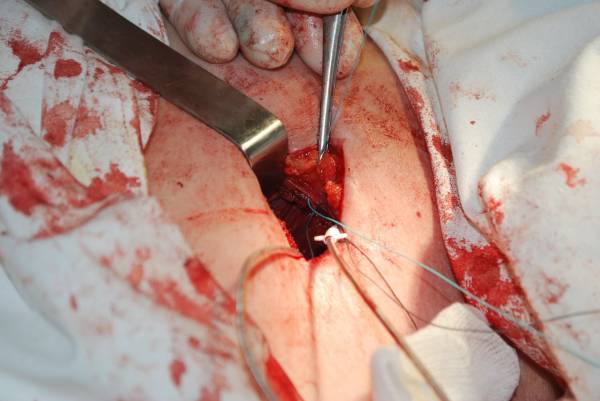 Артериальная гипертензия. Подготовка пациентов с высоким АД к плановым хирургическим операциям