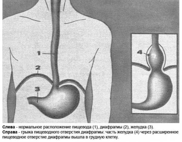 Эндоскопическая картина при грыжах пищеводного отверстия диафрагмы характеризуется