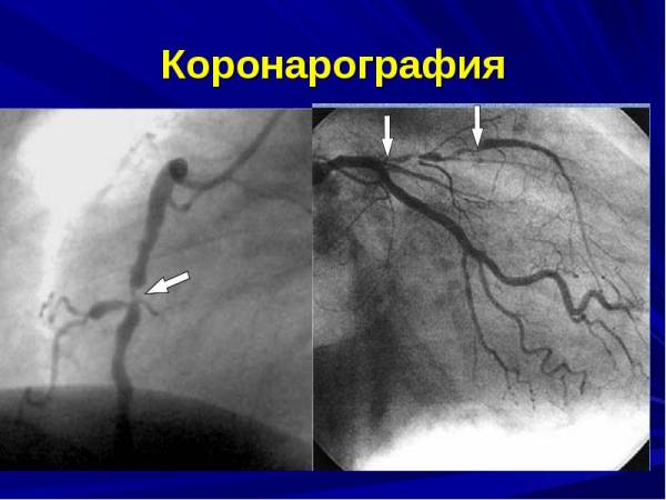 Коронарография сердца фото