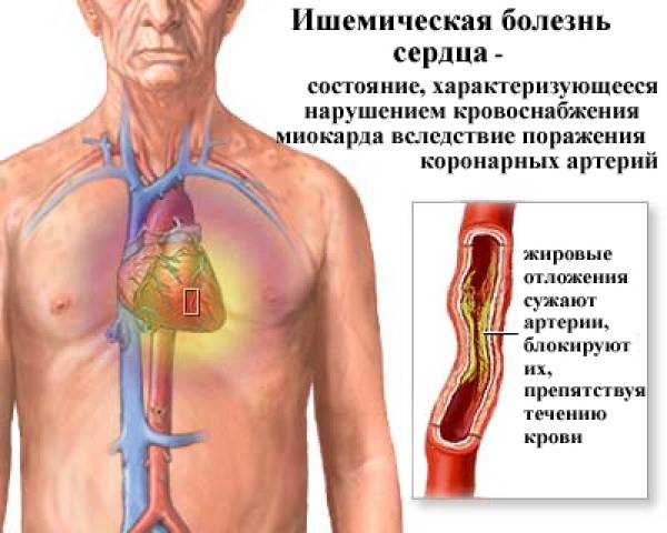Ишемическая болезнь сердца.          Показания к коронарному шунтированию