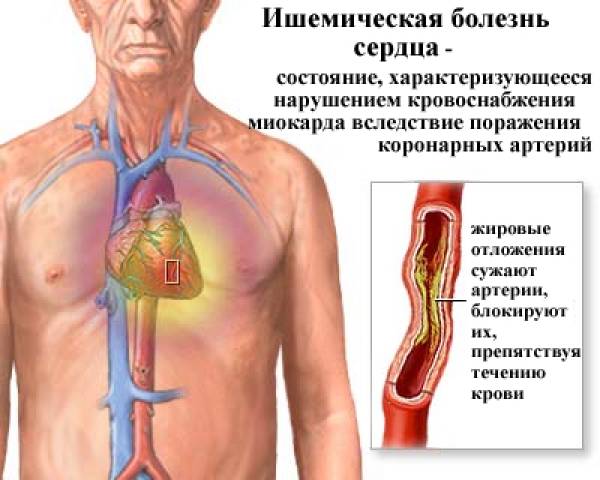 ⚕ Ишемическая болезнь сердца ➡ 【Симптомы, лечение】