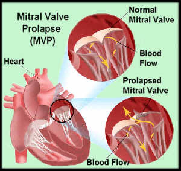 Пролапс митрального клапана у женщины