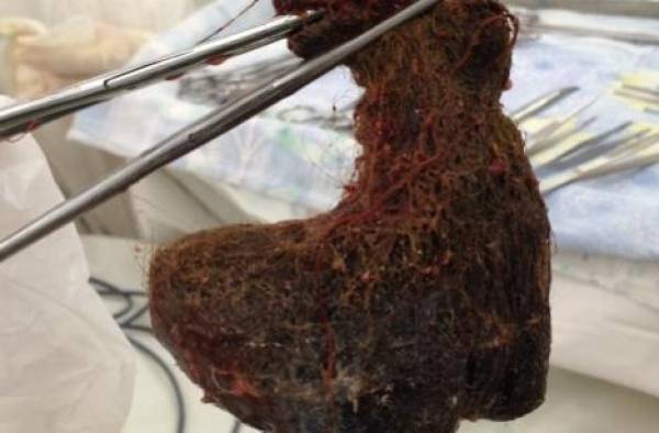 1,5 кг волос удалили из желудка 10-летней девочки в Минской детской областной больнице