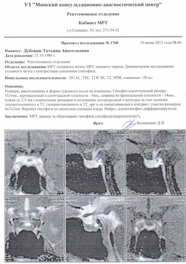 Может ли микроаденома гипофиза влиять на зрение и невозможность зачать ребёнка?