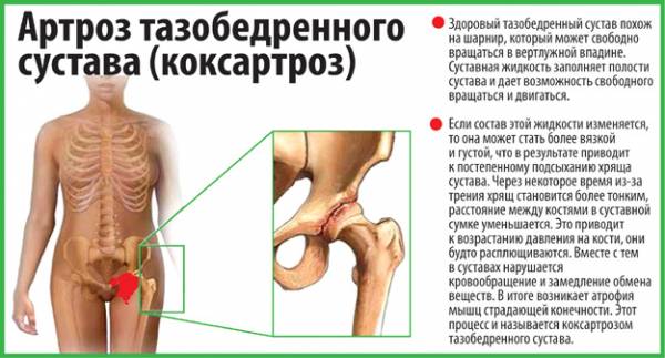 Коксартрозом чаще всего страдают мужчины после 40 лет. Гимнастика при коксартрозе от врача