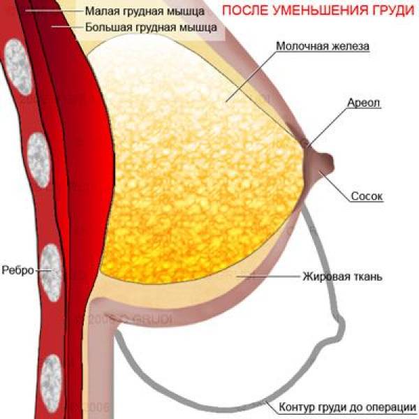 Маммопластика. Увеличение груди в Минске