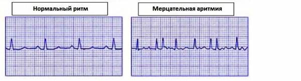 Мерцательная аритмия: обзор