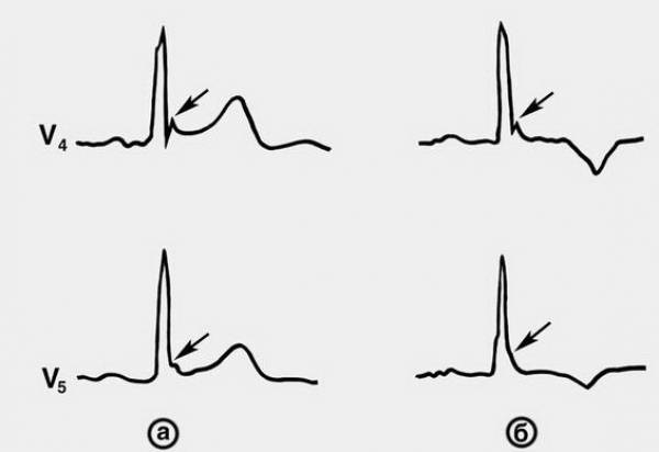 Синдром ранней реполяризации желудочков. Ранняя реполяризация на ЭКГ. Гипокалиемия на ЭКГ реполяризация. Феномен ранней реполяризации предсердий. Двугорбый зубец т.