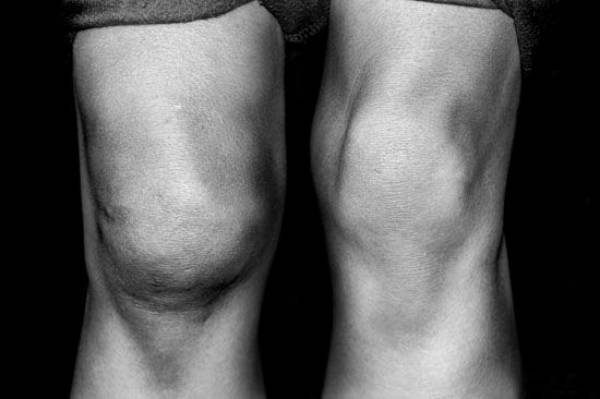 Разрыв мениска коленного сустава: когда нужна операция?