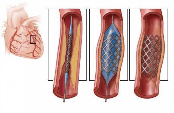 Ангиопластика коронарная. Стентирование. 