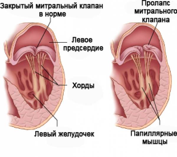 Пролапс митрального клапана (ПМК)