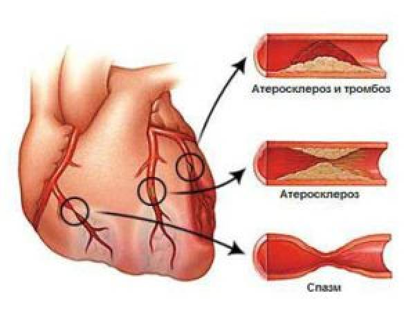 Ишемическая болезнь сердца. Антитромботическая терапия  