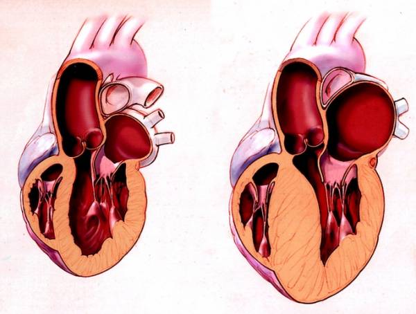 Гипертрофия  миокарда 