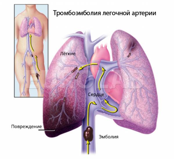 Тромбоэмболия легочной артерии: важные заметки