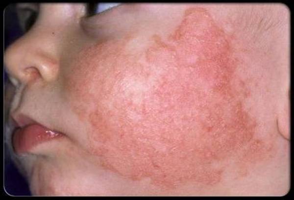 Аллергия на солнце: как выглядит и как её лечить - Лайфхакер