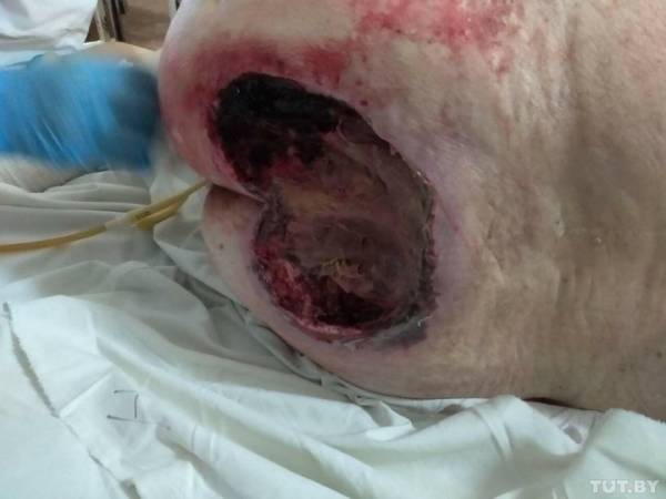 В Пинской больнице у пациента образовались страшные пролежни