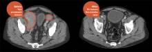 Рассасывание опухолевых масс при лимфоме на пятый месяц лечения (компьютерная томограмма)  David Maloney / Fred Hutch