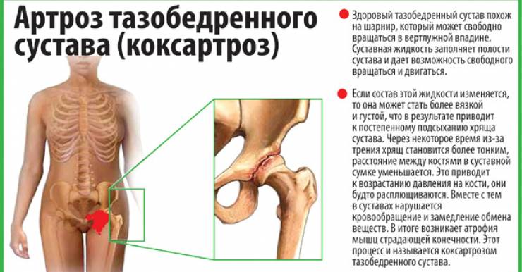 Коксартрозом чаще всего страдают люди среднего возраста (после 40 лет), преимущественно мужчины