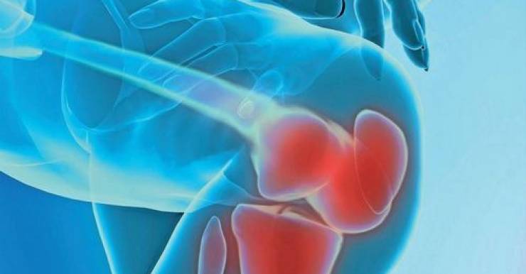 Что касается артроза тазобедренных суставов, или коксартроза, то он самый тяжелый и трудно поддается медикаментозному лечению.