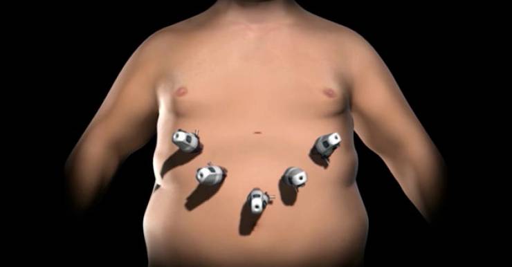 Лапароскопический обходной желудочный анастомоз более опасная операция для тучных пациентов, нежели Лапароскопическая рукавная резекция желудка или Бандажирование желудка, - результаты исследования 