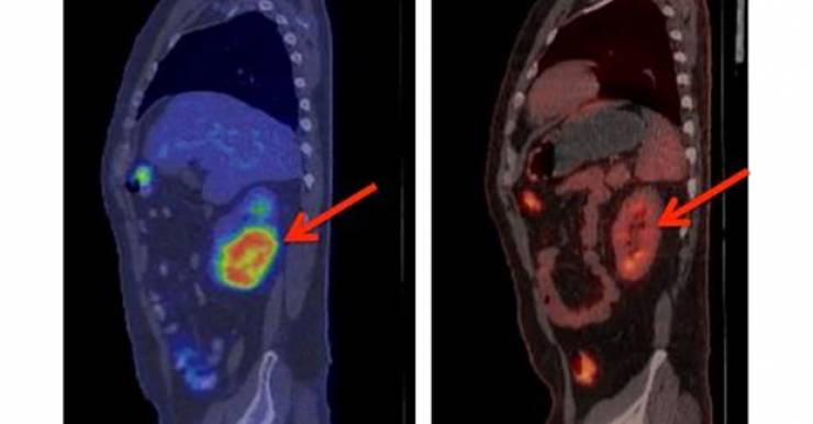 Рассасывание опухоли почки на второй месяц лечения (позитронно-эмиссионная томограмма)  Fred Hutch News Service