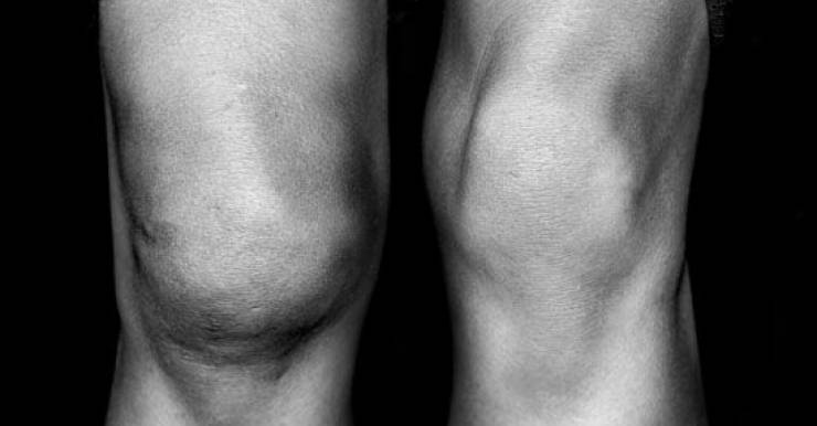Разрыв мениска коленного сустава: когда нужна операция?
