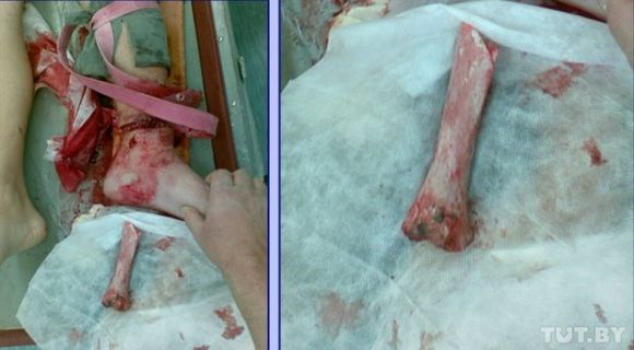 Рваная рана и вылетевшая кость. Таким Сергея привезли в больницу после ДТП. Фото снимка врачей: Анжелика Василевская, TUT.BY Рваная рана и вылетевшая кость. Таким Сергея привезли в больницу после ДТП. Фото снимка врачей: Анжелика Василевская, TUT.BY