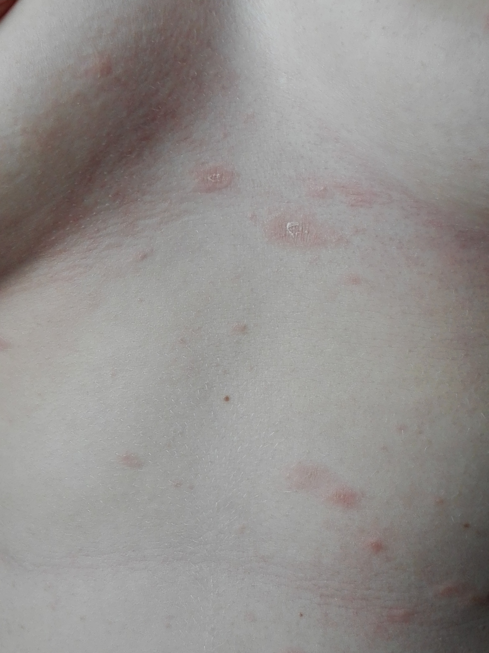 красные пятна на груди и животе у женщин фото 3