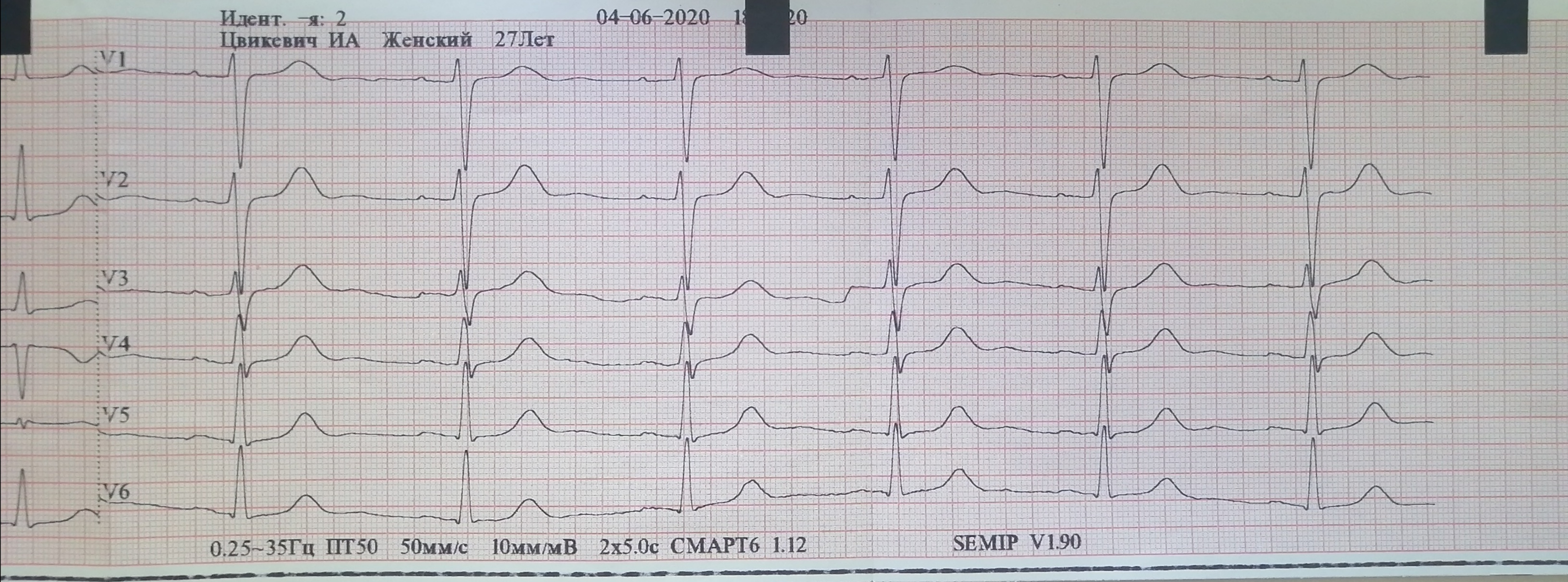 Расшифровать экг по фото