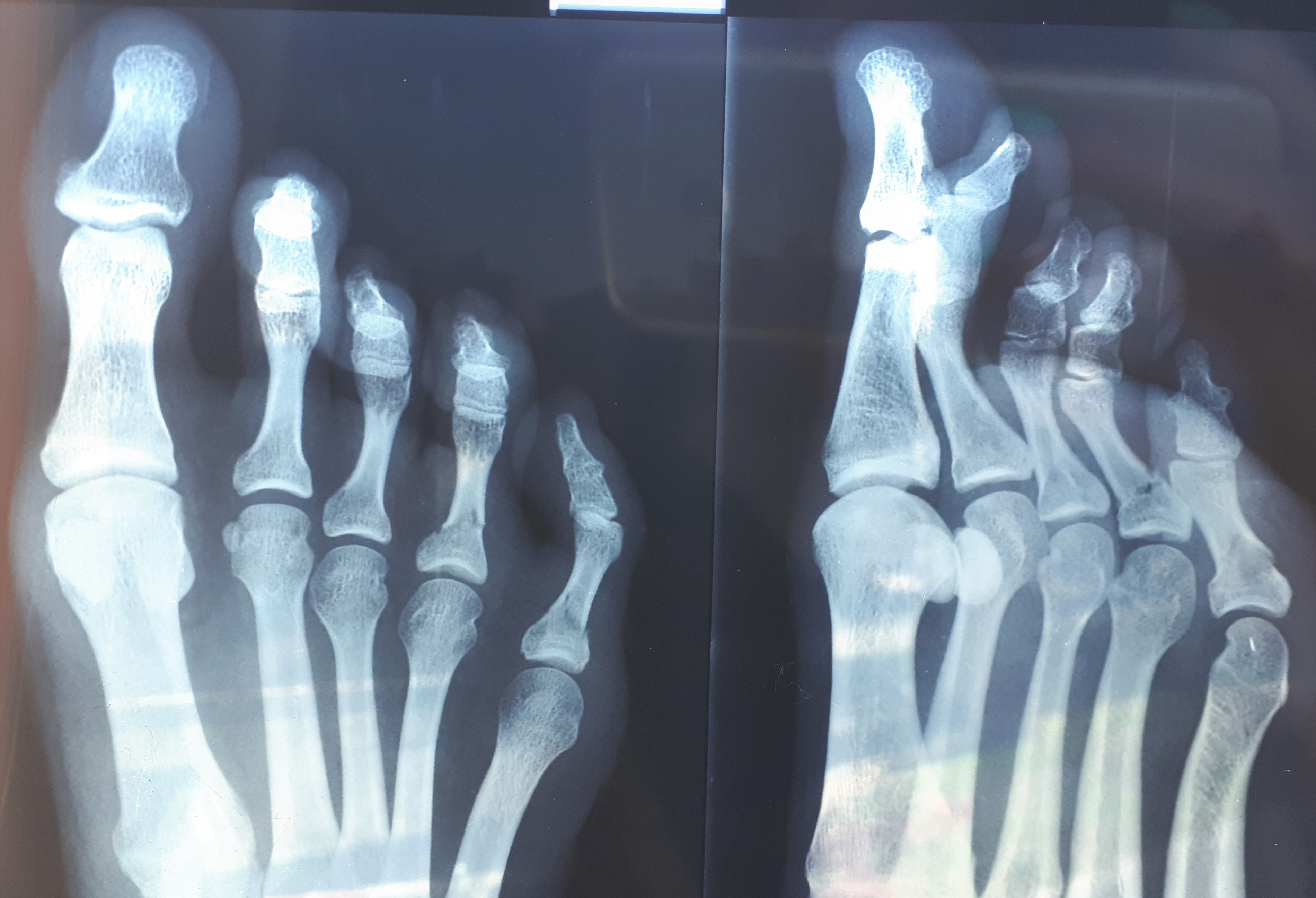 Ногтевая фаланга ноги. Краевой перелом фаланги рентген. Перелом фаланги пальца рентген. Перелом фаланги 5 пальца стопы рентген. Перелом основной фаланги 1 пальца стопы рентген.